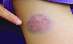 هل يوجد دواء للحمى النزفية؟.. الصحة تجيب